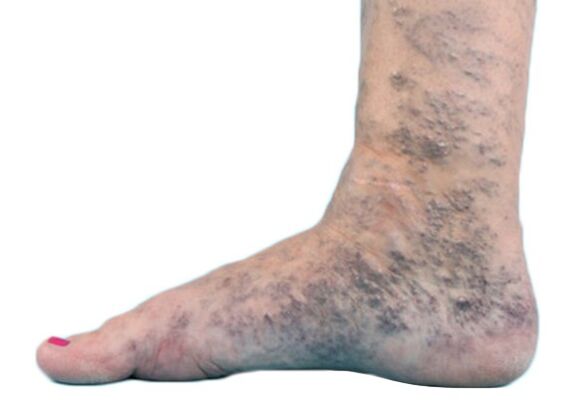Varices sur les jambes