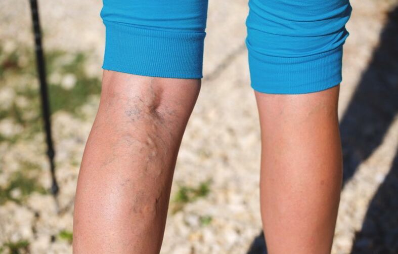 Dommage aux membres inférieurs