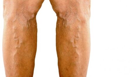 Manifestations visibles des varices sur les jambes