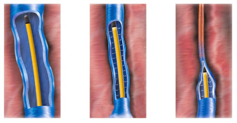 Ablation par radiofréquence comme méthode de traitement des varices