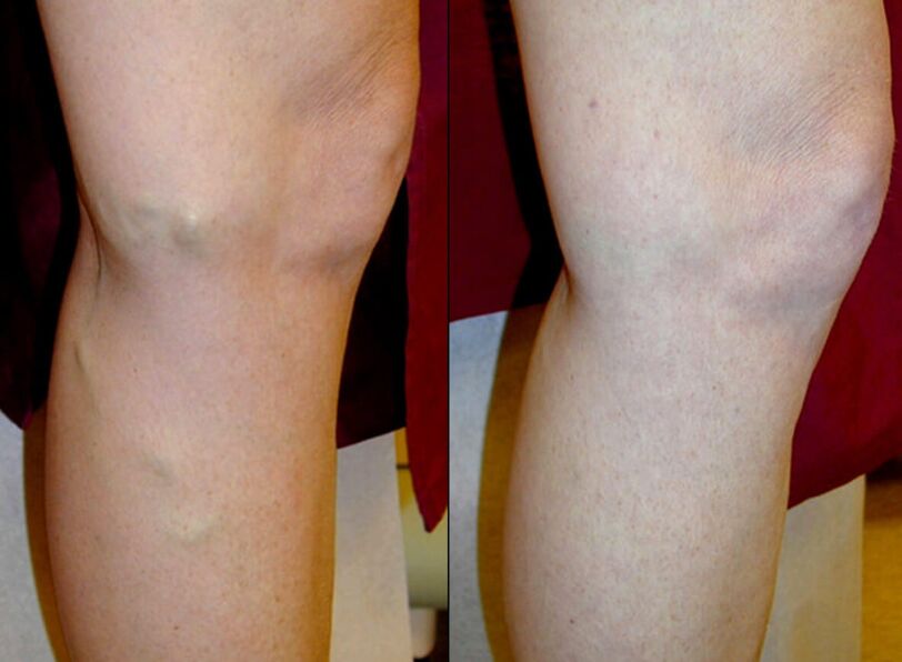 Méthodes de traitement des varices sur les jambes