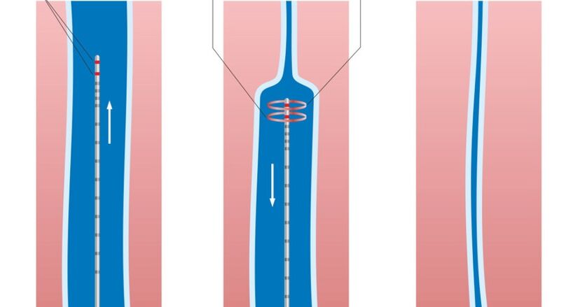 Traitement au laser des varices des jambes