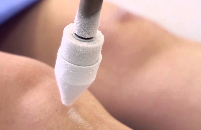 Traitement des varices des jambes par cryothérapie